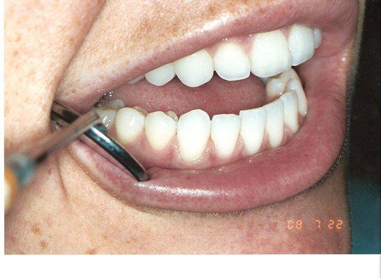 Internal Whitening After