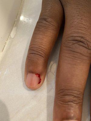 Bleeding cuticles