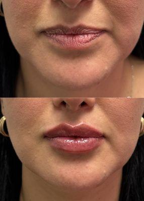 First time lip filler patient. Goals were plump, soft, and subtle lip enhancement. Individual results may vary.