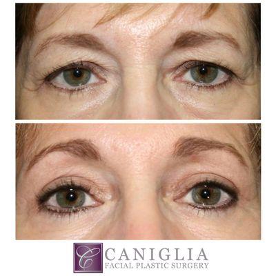 63 year old patient shown three months post-endoscopic forehead lift (browlift), upper & lower eyelid surgery  (blepharoplasty).