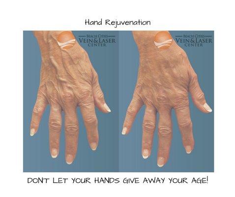 Hand Rejuvenation - helps your hands look and youthful, refreshed and beautiful as you feel. May include vein removal, fillers, age spot tx