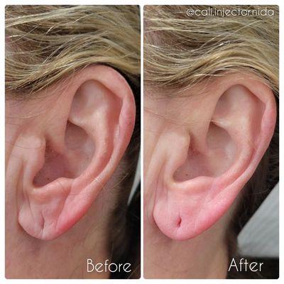 Ear lobe Filler