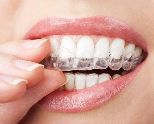 Try Invisalign treatment at Dr. Dann Orthodontics today!