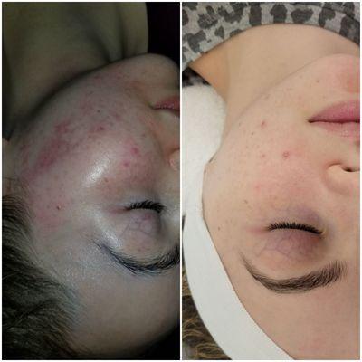 Acne treatment plus scars correction