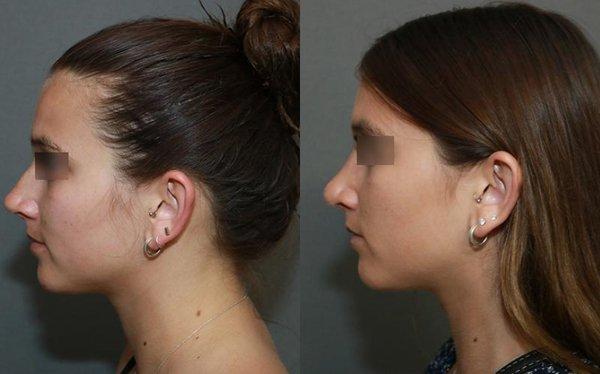 This young woman wanted the hump on her nose removed without a big change to her tip. She underwent an aesthetic rhinoplasty.