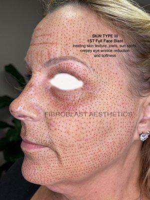 Full face tightening and rejuvenation