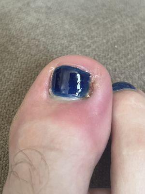 My infected toe that has puss.