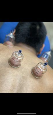 Cupping