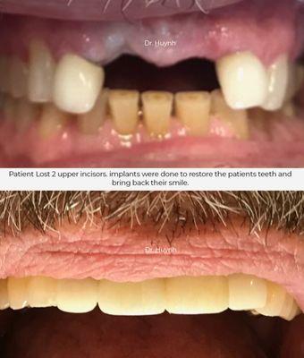 Patient lost top 2 incisors and they were replaced with new implants to restore the teeth and smile.