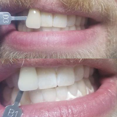 Zoom Whitening