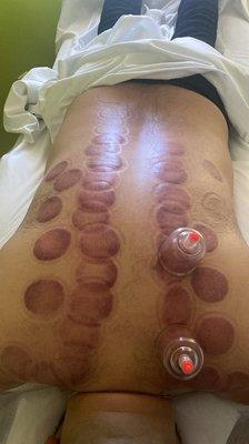 Cupping therapy