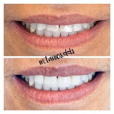 Minimally prepped veneers to enhance our patient's beautiful smile!