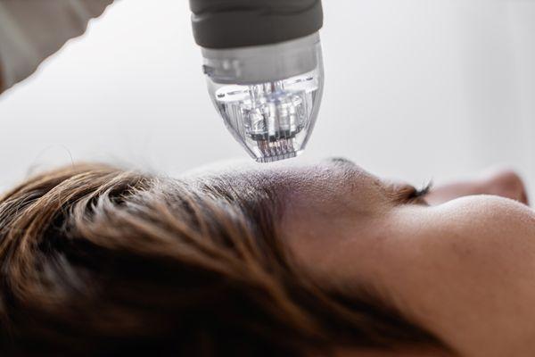 Microneedling; LED or Radiofrequency