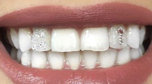 We are currently the one establishment in the Twin Cities area certified by Tooth Kandy gems, the original national company for tooth gems.