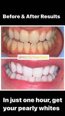 Amazing Before & After Pearly White Teeth