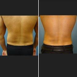 Smoother Back B&A Liposuction