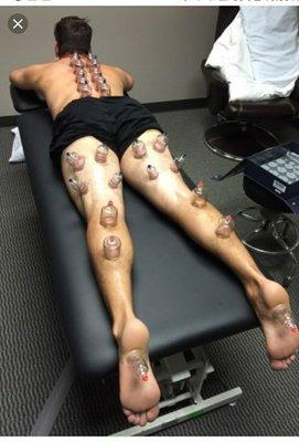 Cupping Services