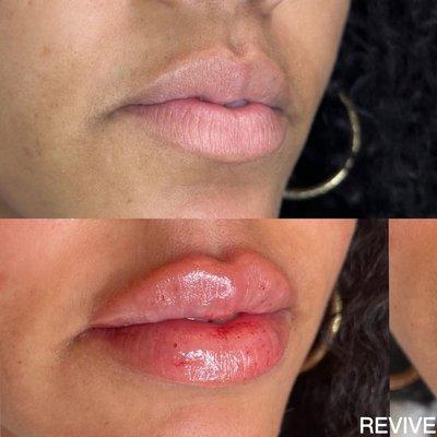 lip filler 1 syringe before and after