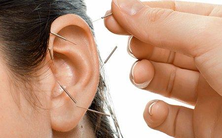 Ear Acupuncture