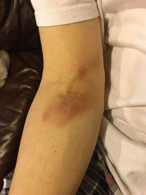 The bruising caused by the nurse Betsie. Terrible.