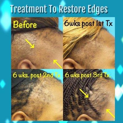 Micro-needling with PRP to restore hair to edges due to traction alopecia