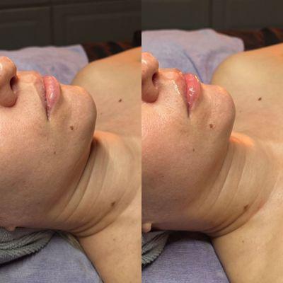 Neck lift - non invasive