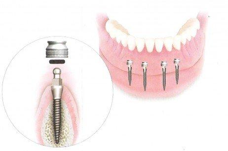 Lower Implants with Overdenture