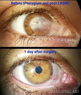 Meticulous care was needed in order to remove this growth without disturbing the underlying LASIK flap