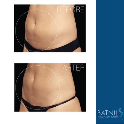 msculpt® uses contractions to build muscle and trim fat for the perfect toned look!