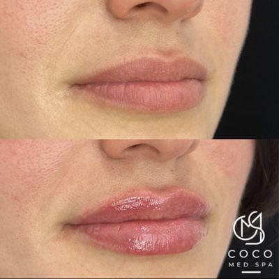 Lip filler by Jessica Suber