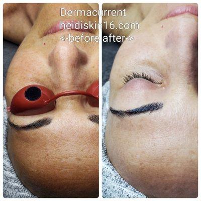 Looking for Brightening your skin? Come to get facial Dermacurrent or Dermalight