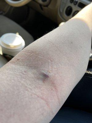 Right after blood draw. Worst one ever