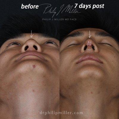 Rhinoplasty, before and after.