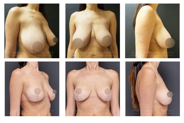 Breast Lift Asymmetric Breasts Nipple Reduction Breast Reduction Liposuction of breast LipoLift