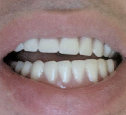 In this picture you can see how poorly aligned the lower teeth are in compared with the upper plate.