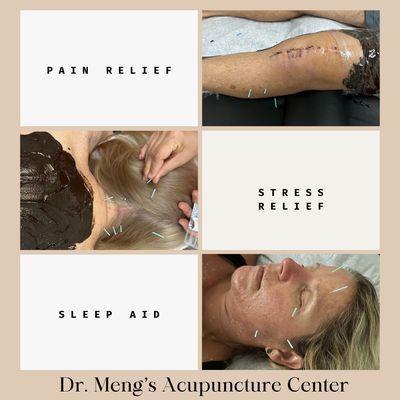 Acupuncture for pain relief, stress relief and sleep aid.