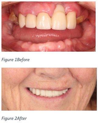 Full mouth implant rehabilitation