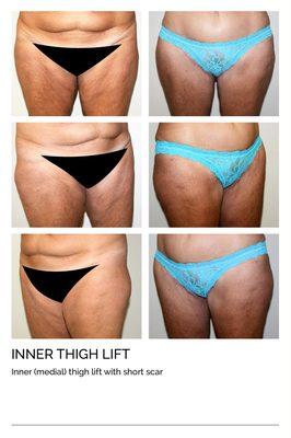 Inner Thigh Lift