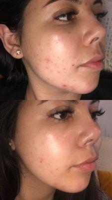 Results from a chemical peel