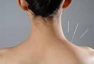 Acupuncture heals headaches & neck pain very well.