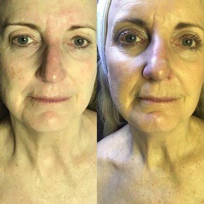 Fibroblast Skin Tightening