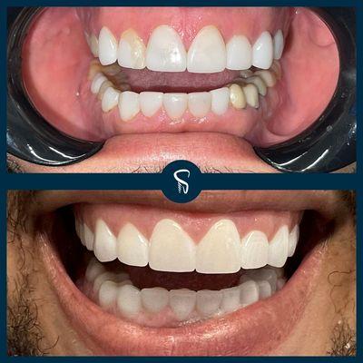 Cosmetic Dentistry and Porcelain Veneer Before and After