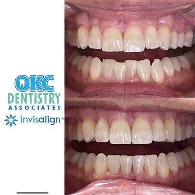 Does the crowding of your lower teeth bother you?  In just a few months we can help you get that confident smile you have always wanted!