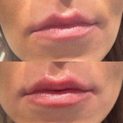 Before and after lip filler with Angie