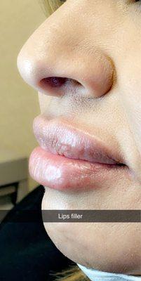 Lips filler