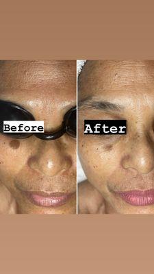 Chemical peel 1 session with Home perscriptive.