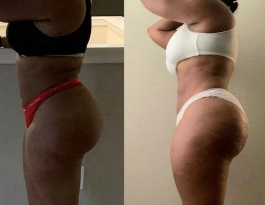 Body contouring before ad after