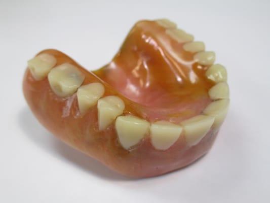 AFTER - 2 hrs later - A new denture is still needed due to worn teeth, but this repair allows the patient to eat & smile again!