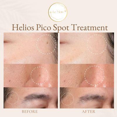 Helios Pico Spot Treatment