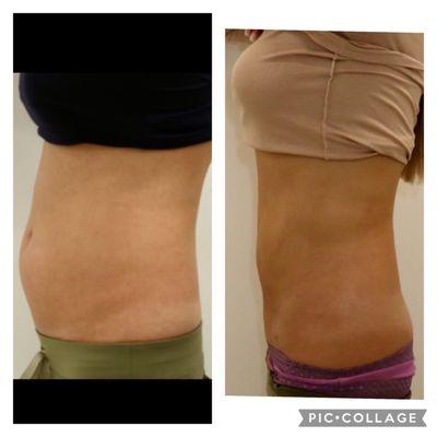 Abdominal lipo before and after